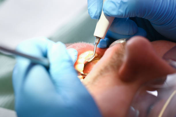 Best Urgent Care for Lost Fillings or Crowns in St George, UT