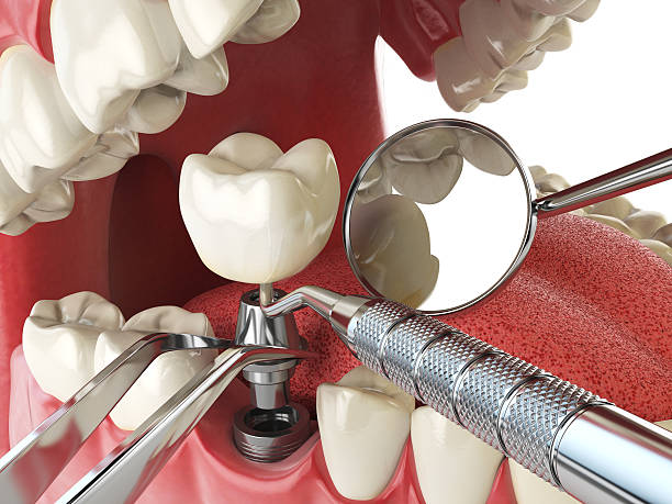 Best Emergency Dental Care for Broken or Chipped Teeth in St George, UT
